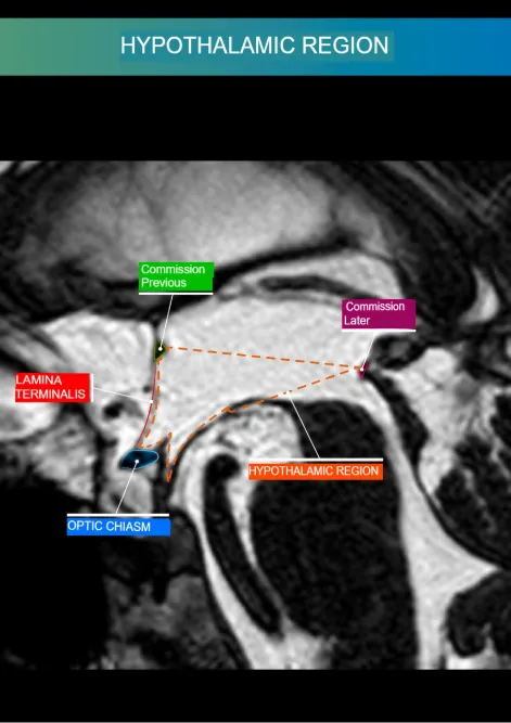 Hypothalamic region exercise preview
